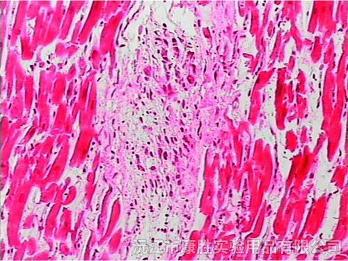 风湿性心肌炎切片