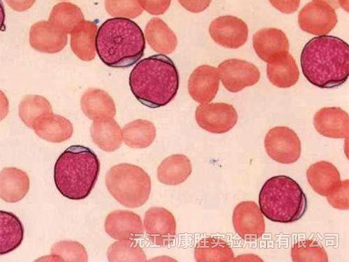 急性髓细胞白血病未成熟型（M1)